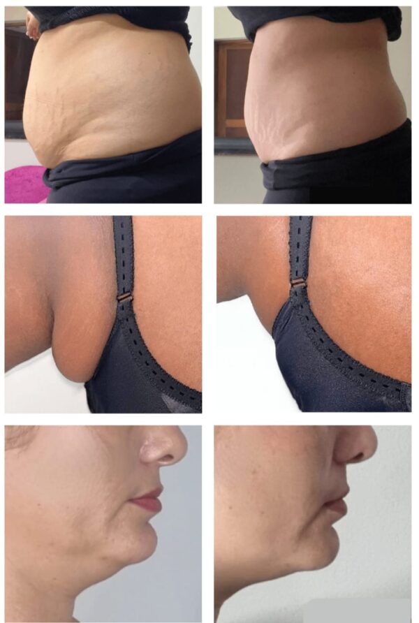 Lipo-Action Pro Weightloss Injection