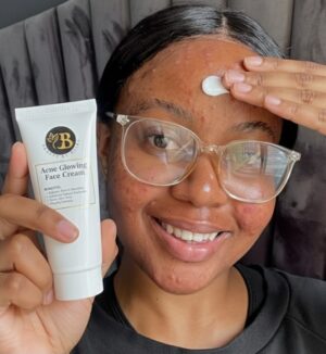 Acne Glowing Face Cream