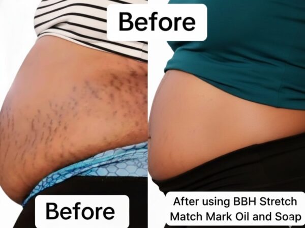 Stretch Mark Oil
